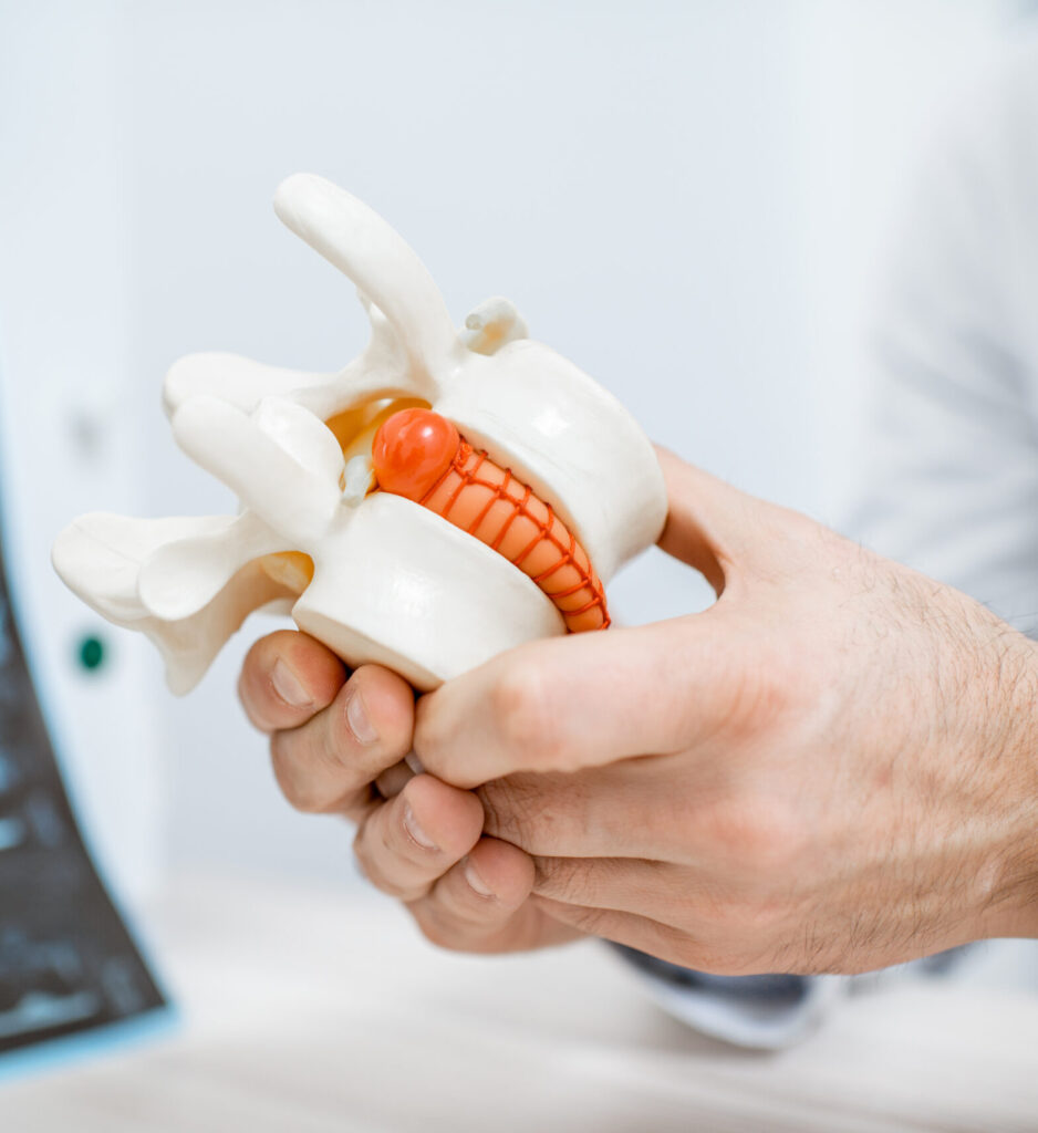 Doctor holding model of herniated disc