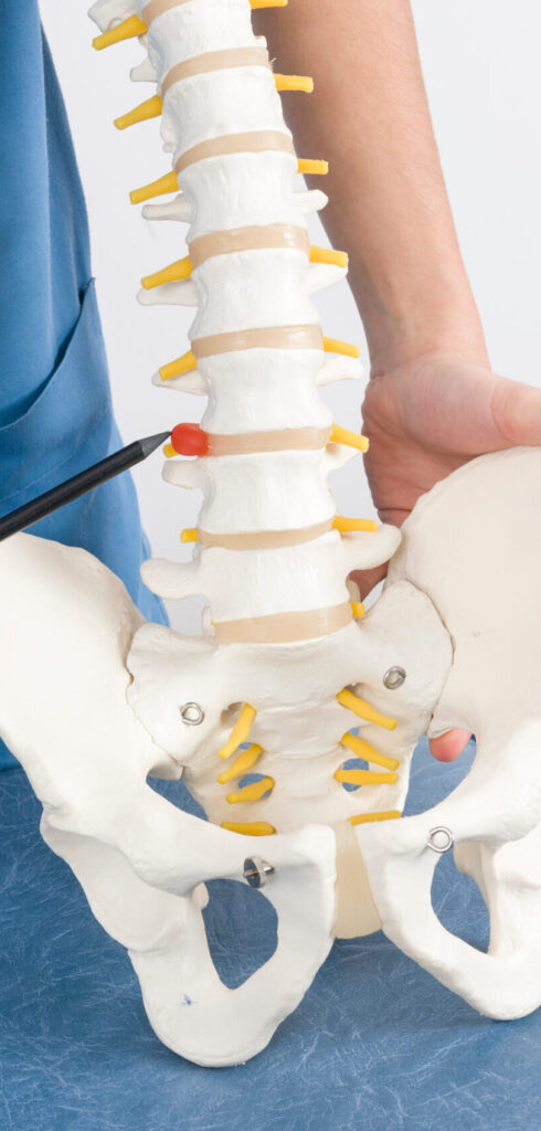 Doctor showing herniated disc on model of spine